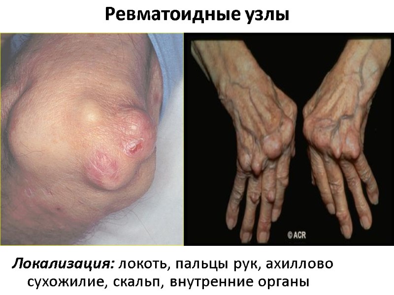 Ревматоидные узлы Локализация: локоть, пальцы рук, ахиллово сухожилие, скальп, внутренние органы